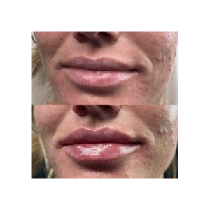 Lips of a women before and after treatment