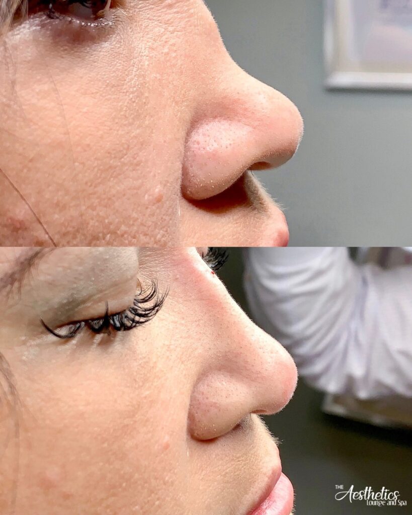 Liquid Rhinoplasty at The Aesthetics Lounge and Spa Venice: Non-Surgical Nose Perfection