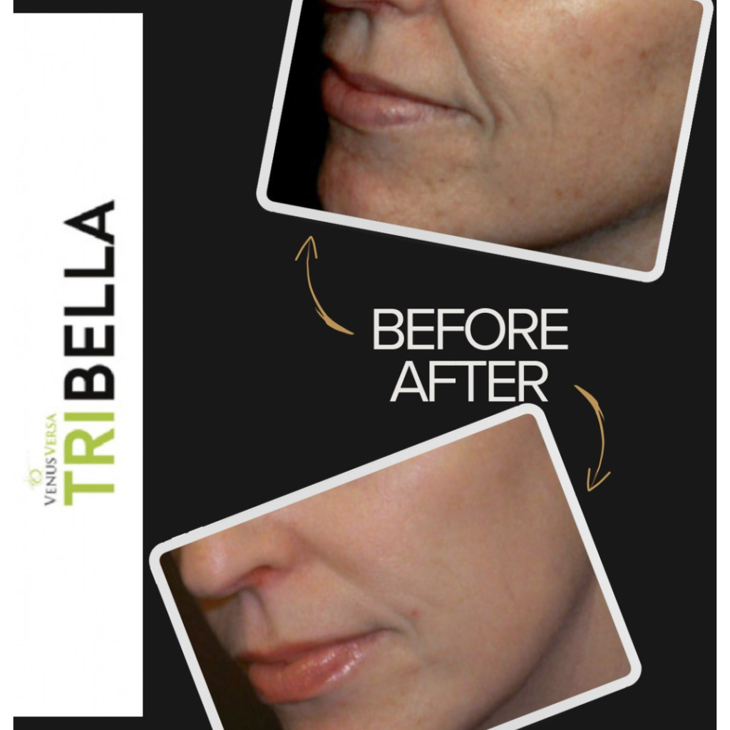 Elevate Your Skin with Tribella at The Aesthetics Lounge and Spa Venice